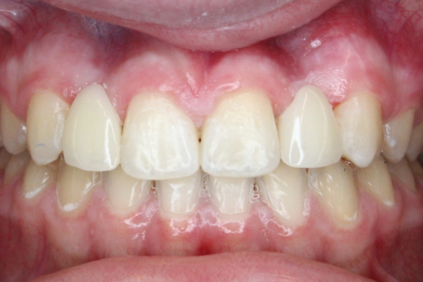 After Lanier Valley Dentistry treatment