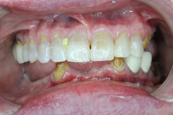 Before Lanier Valley Dentistry treatment