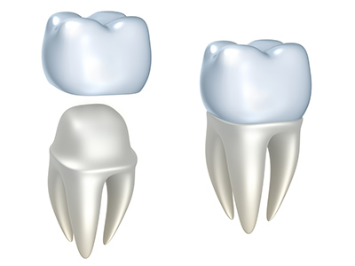 Five Types of Dental Crowns