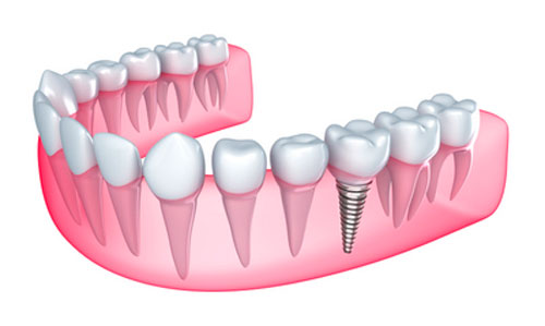 What Are The Benefits of Having Removable and Fixed Implant Dentures?