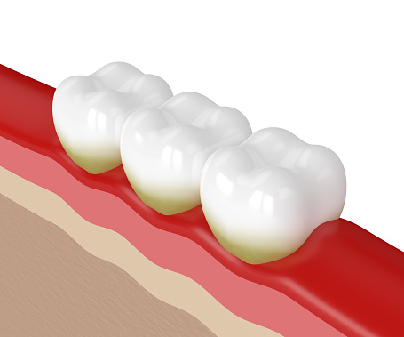 a 3d rendering of the stages of gum disease