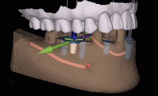 X-guide 3D model from Lanier Valley Dentistry
