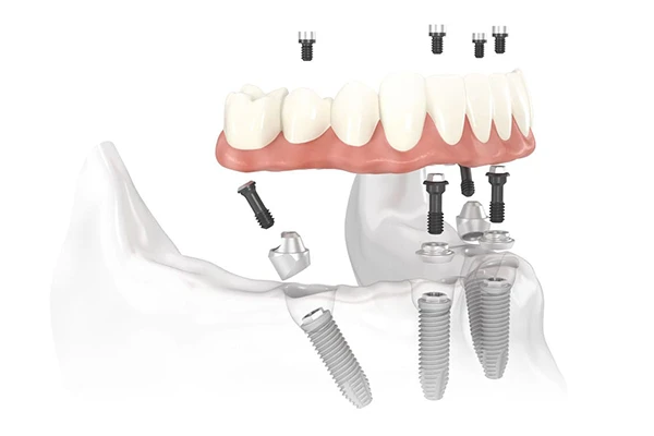 3D rendering of the all on 4 treatment concept dental implant Lanier Valley Dentistry in Dacula, GA