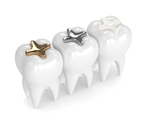 3D rendering of three teeth each with a different dental filling material