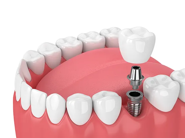 3D rendering of a dental implant and its components being placed into the jaw Lanier Valley Dentistry in Dacula, GA