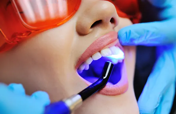 A Close up of a dental assistant applying a UV light to a white female patient's newly sealed teeth in Dacula, GA
