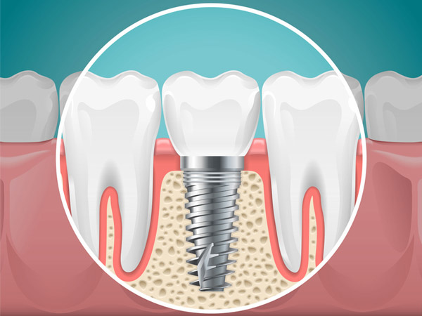  Diagram of a tooth replaced with a dental implant from Lanier Valley Dentistry in Dacula, GA
