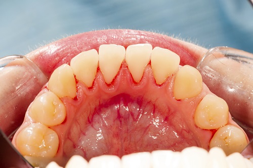 Preventing Gum Disease: 4 Ways