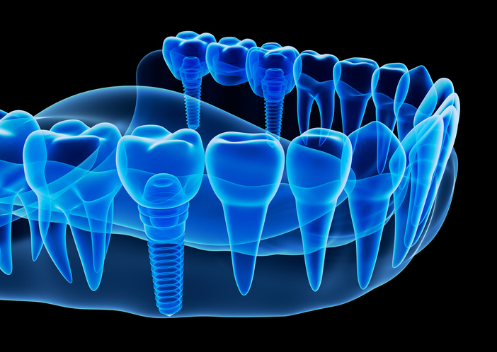 An image of dental implants in Dacula, GA
