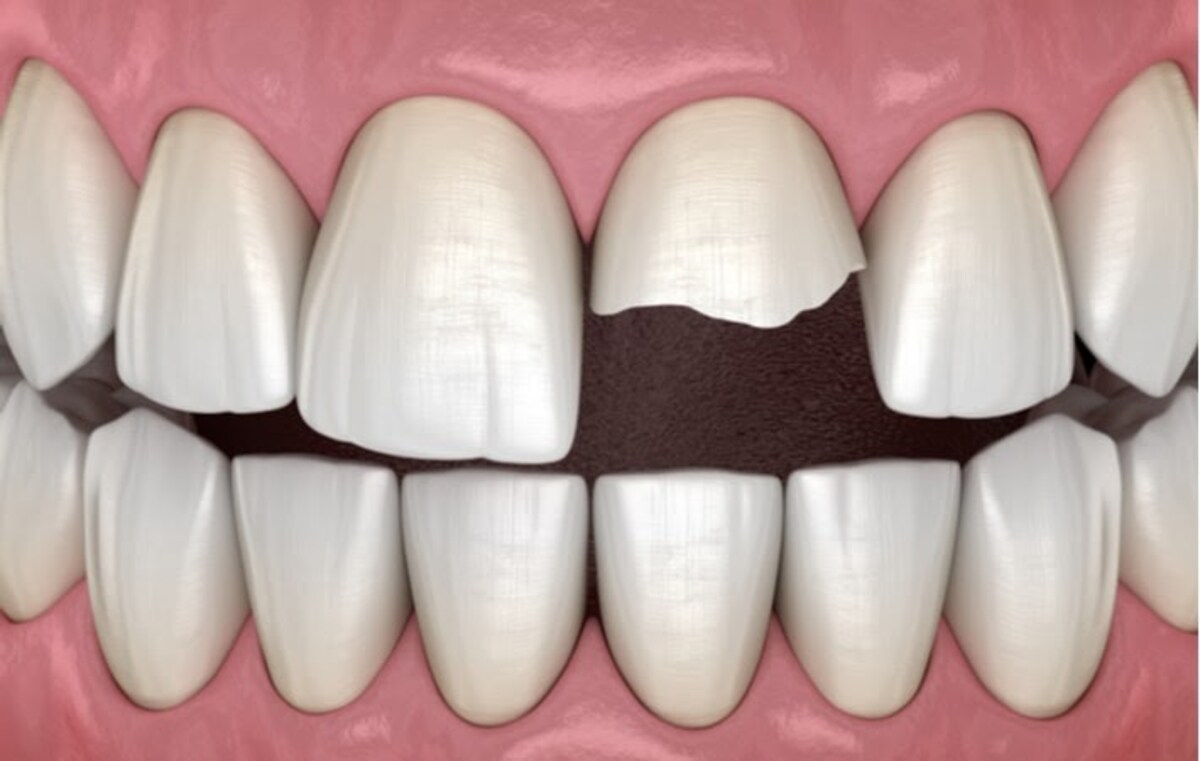 why does a damaged tooth need to be treated and how do crowns help