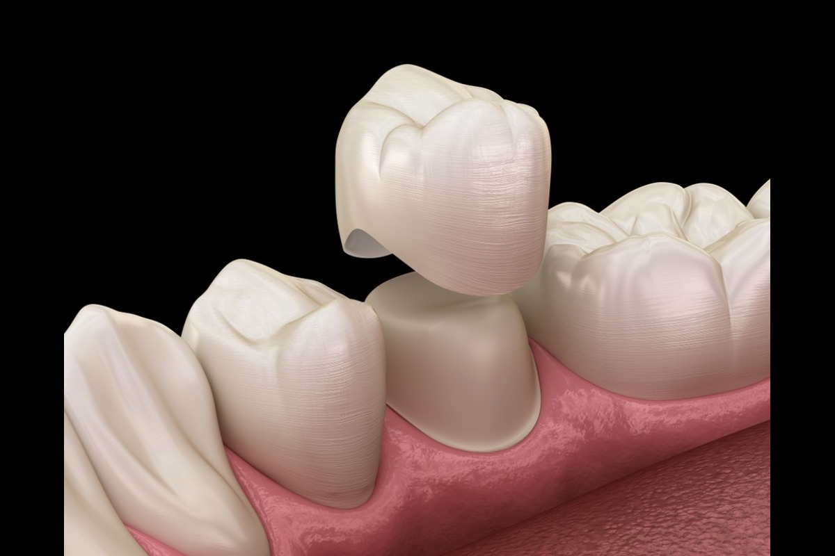 is there anything to remember about caring for new dental crowns