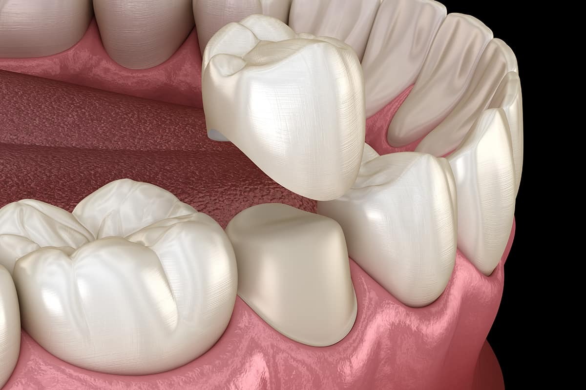 five types of dental crowns
