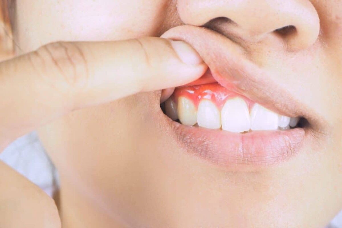 what can cause bleeding gums aside from gum disease