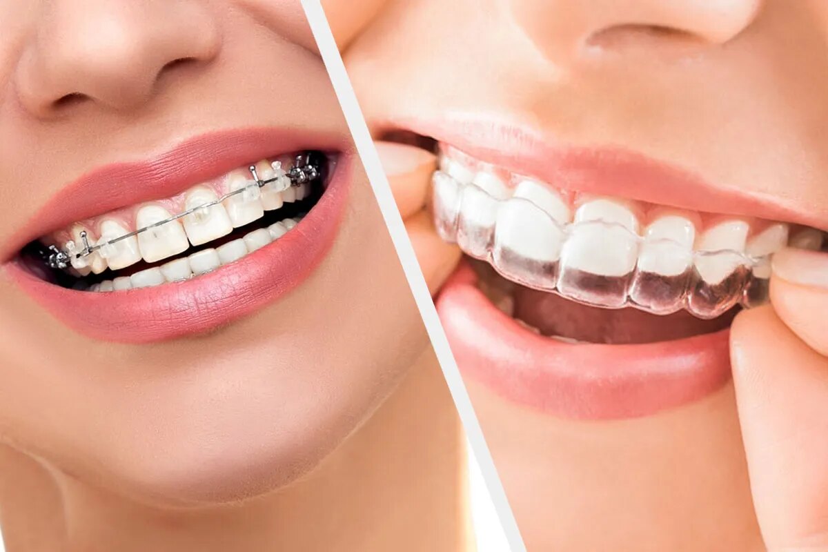 veneers vs braces which option is the best for you