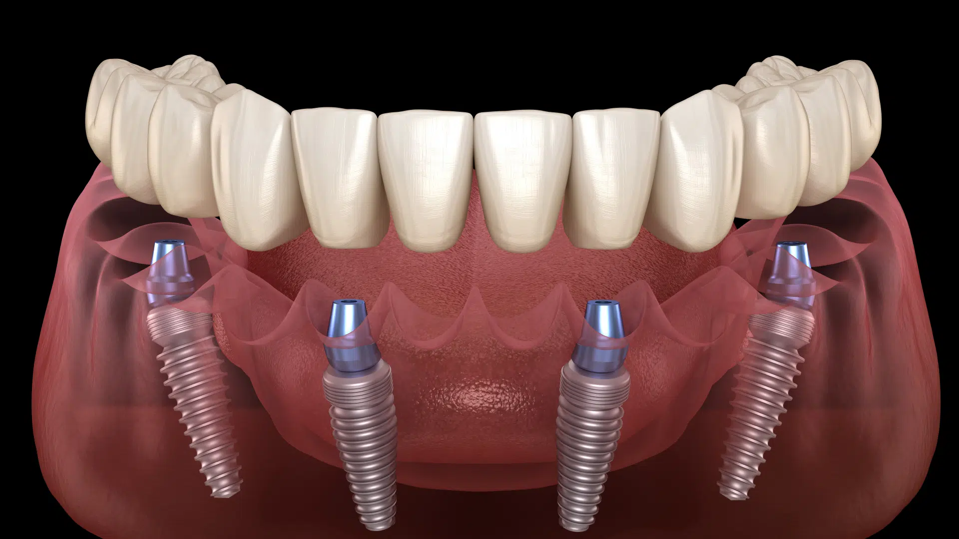 what are the benefits of having removable & fixed dentures