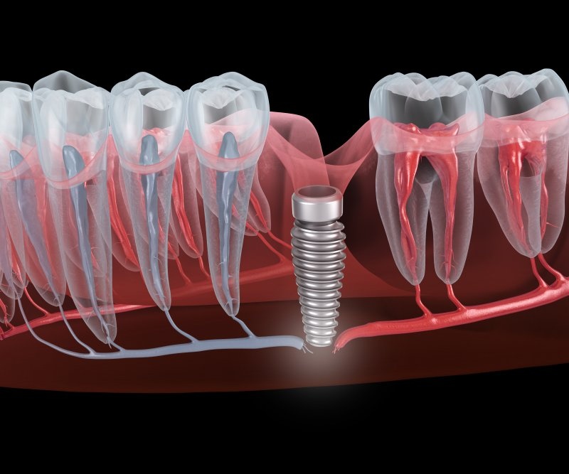 signs of dental implant failure