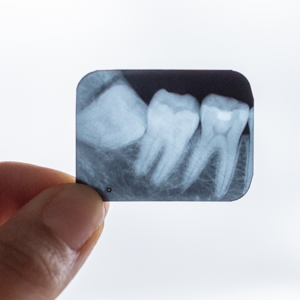 wisdom tooth extraction dacula