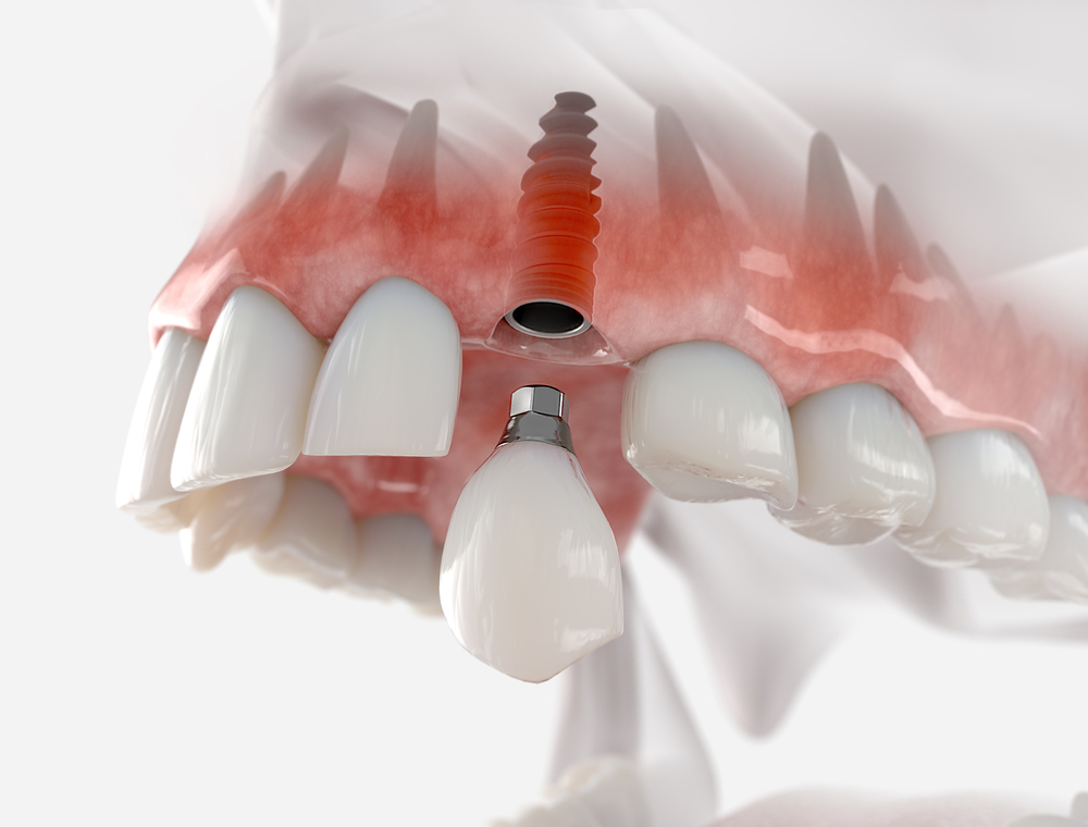 What Are Zygomatic Dental Implants