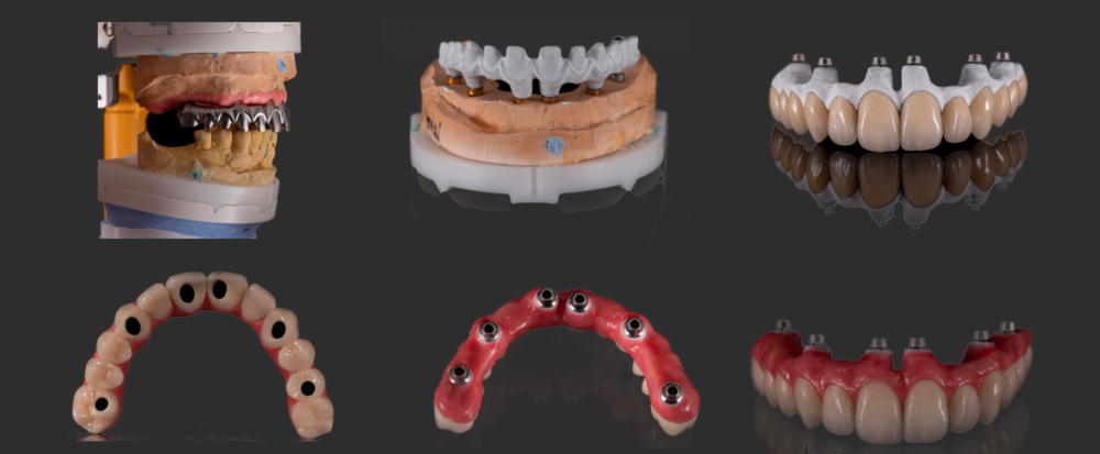all on 4 dental implants dacula