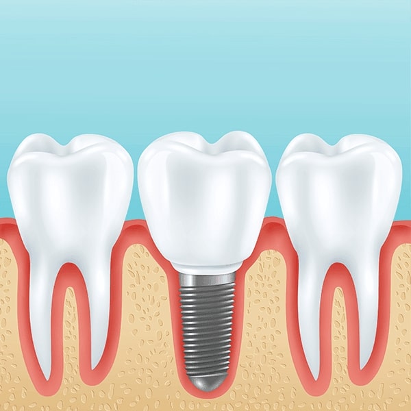 dental implants procedure dacula