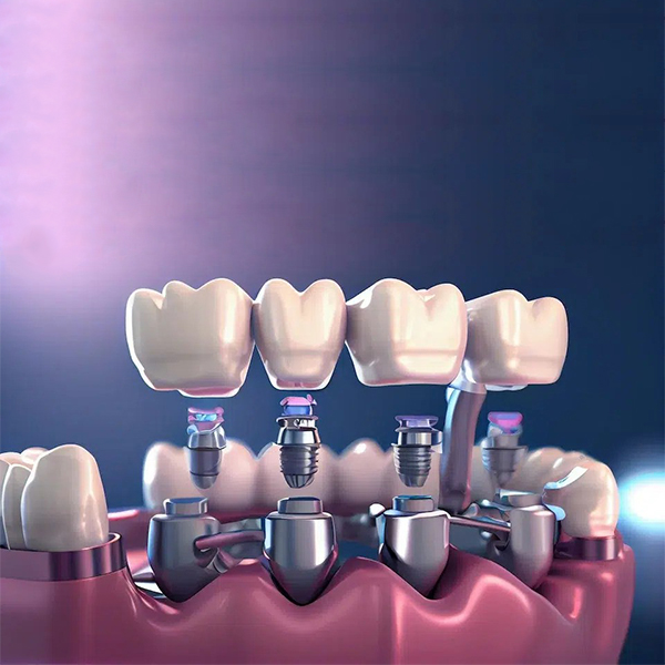 multiple tooth implants dacula