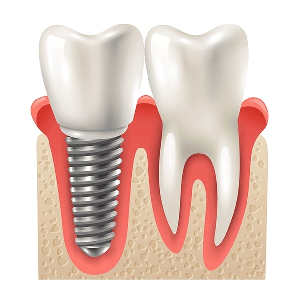 single tooth implants dacula