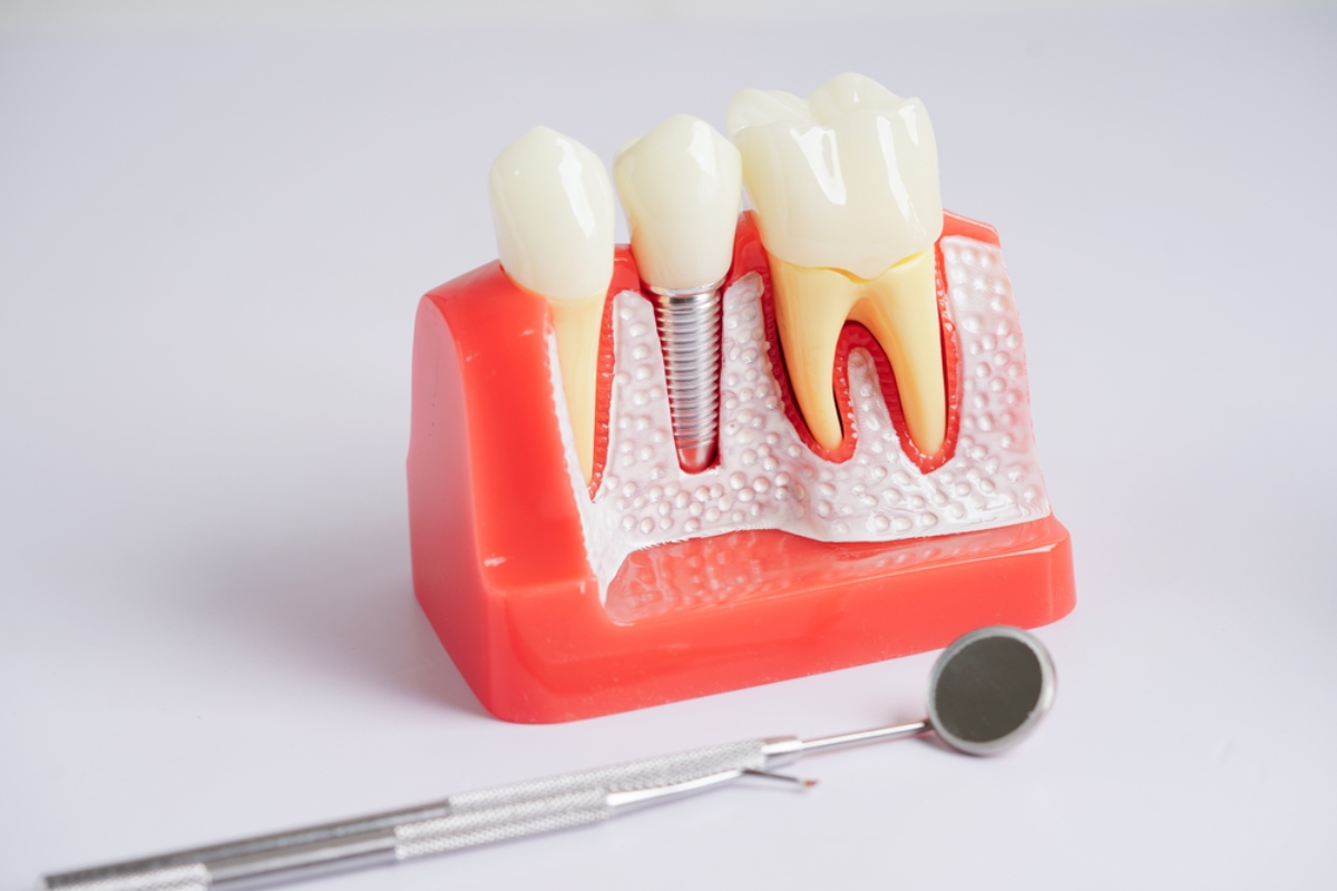 benefits of dental crowns protect and perfect your smile