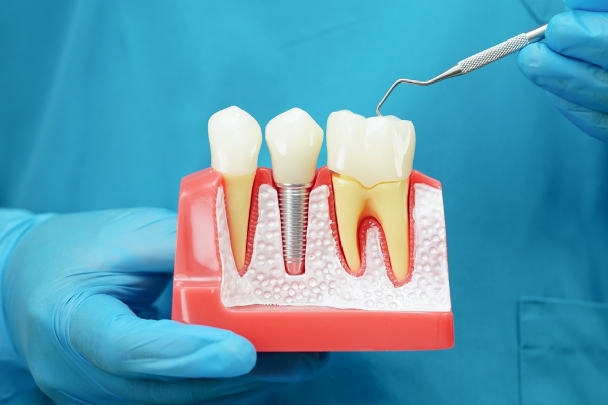 how bone grafting enhances dental implant longevity